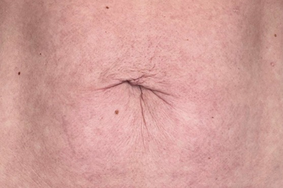 rimodellamento corpo (1) Primo piano dell'ombelico su addome umano