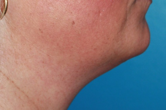 Primo piano della mascella con acne