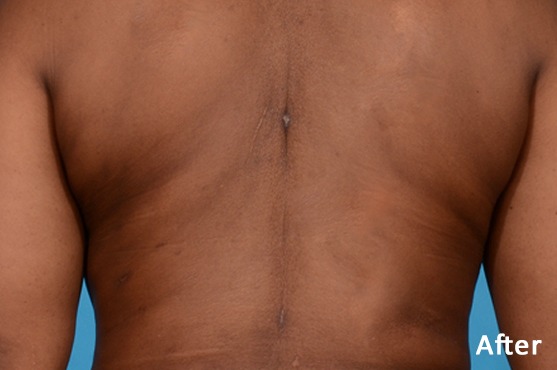 rimodellamento corpo (5) Torace maschile dopo trattamento estetico